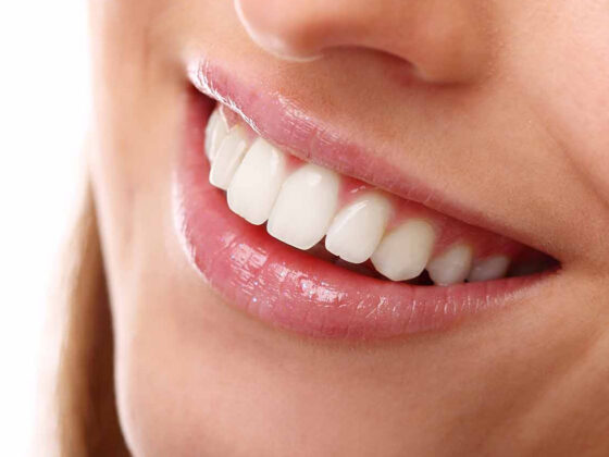 Lucariello Odontoiatria - Come avere denti bianchi