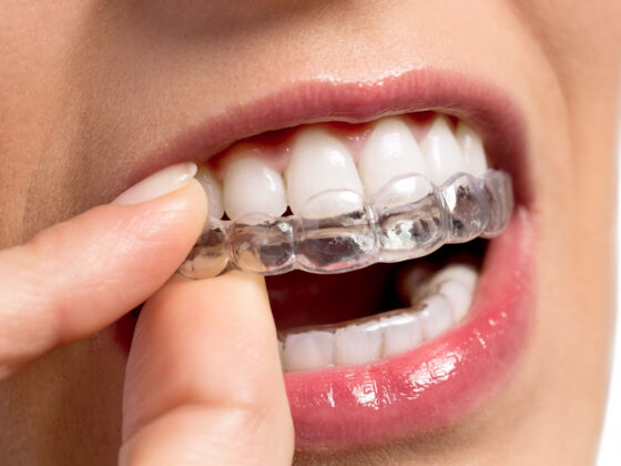 Lucariello Odontoiatria - Invisalign