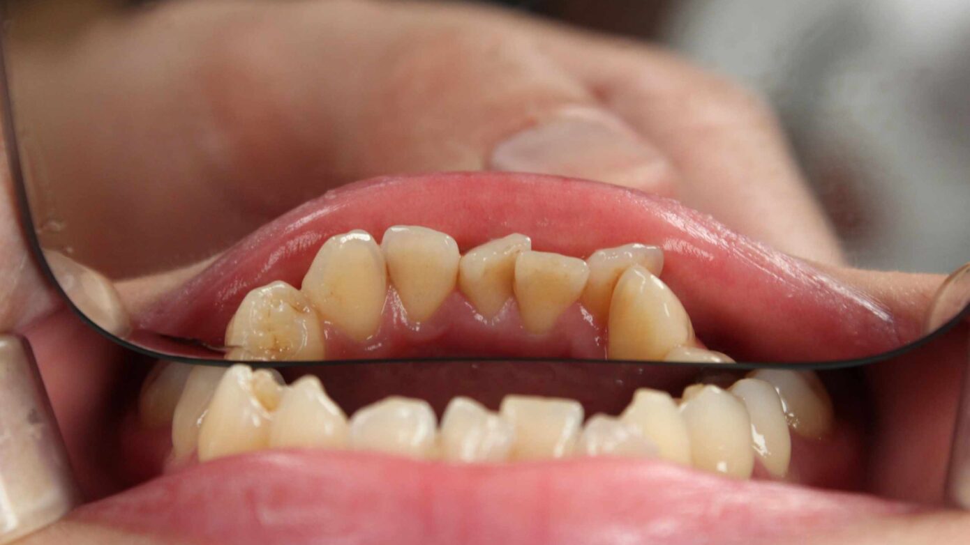 Lucariello Odontoiatria - Rilevatore di placca